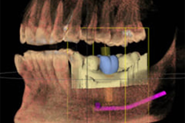歯科用CT「ORTHOPHCS　XG　3D」